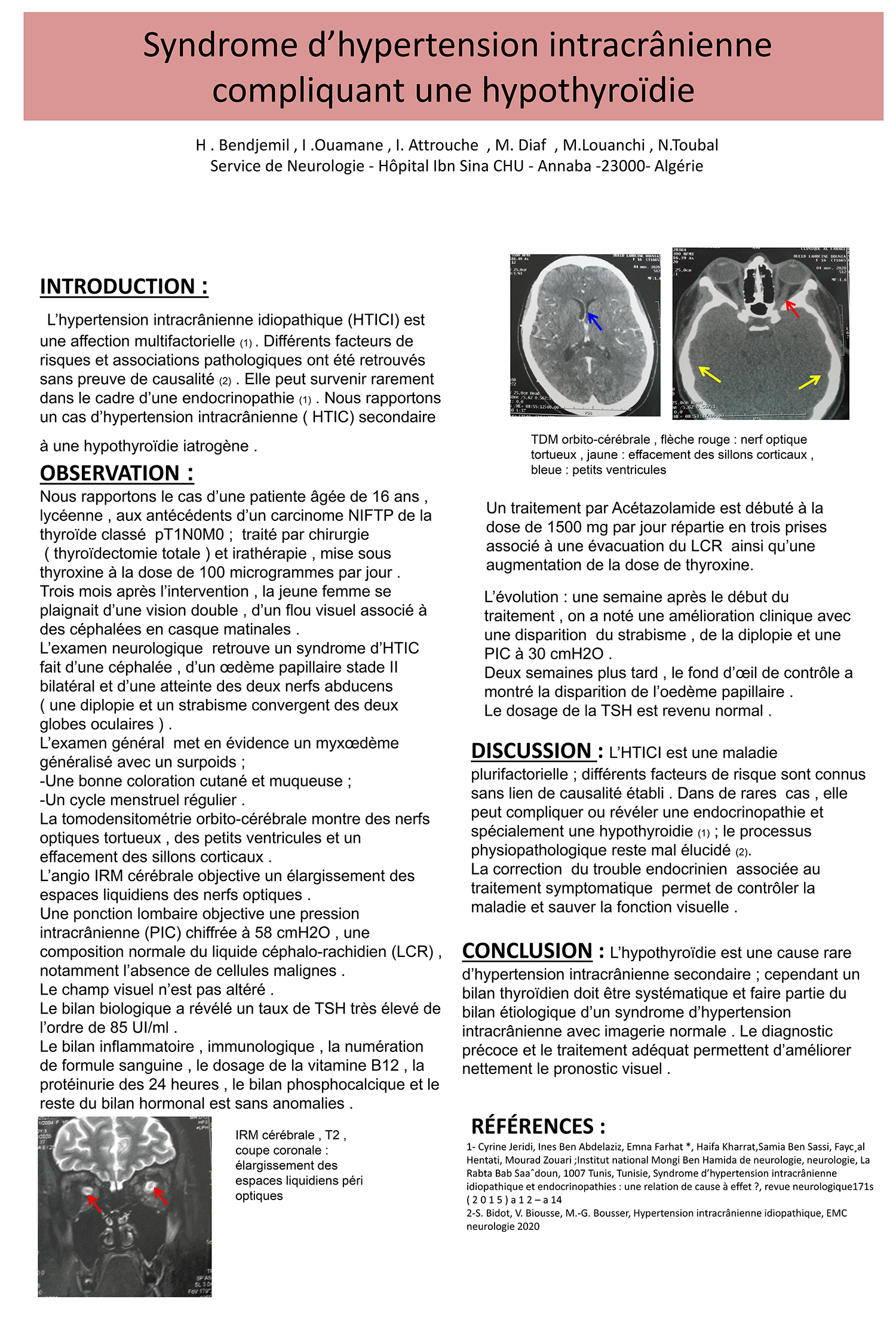 Syndrome d’hypertension intracrânienne compliquant une hypothyroïdie