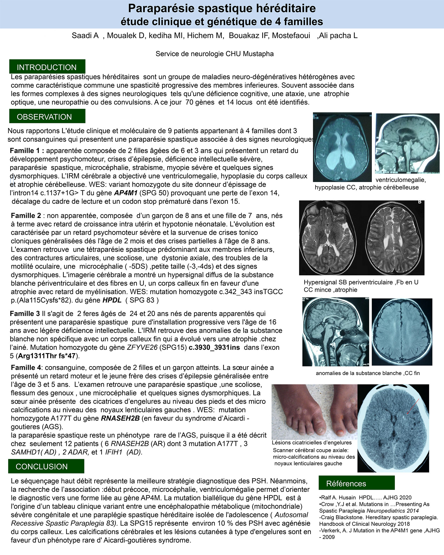 Paraparésie spastique héréditaire étude clinique et génétique de 4 familles
