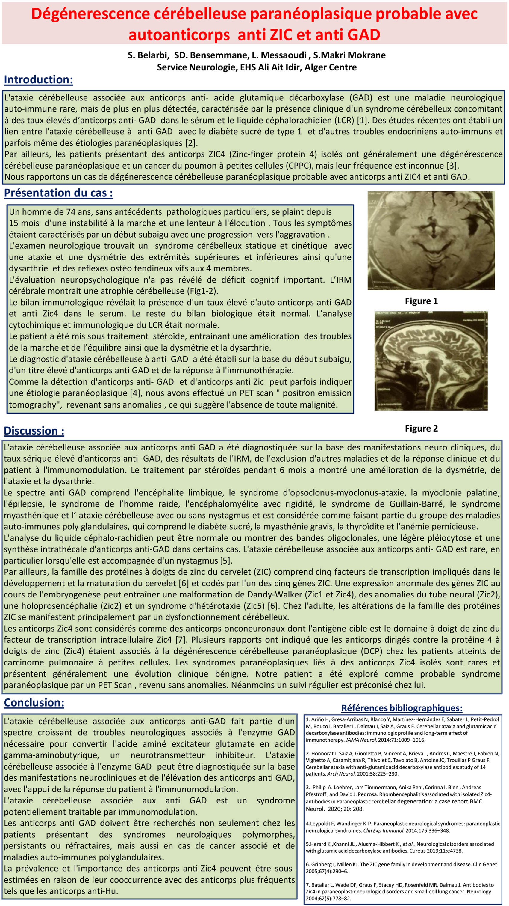 Dégénerescence cérébelleuse paranéoplasique probable avec autoanticorps  anti ZIC et anti GAD
