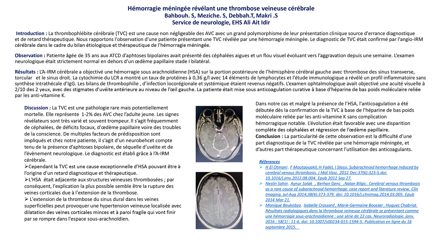 Hémorragie méningée révélant une thrombose veineuse cérébrale