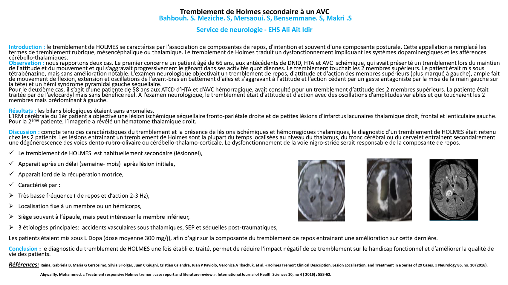 Tremblement de Holmes secondaire à un AVC