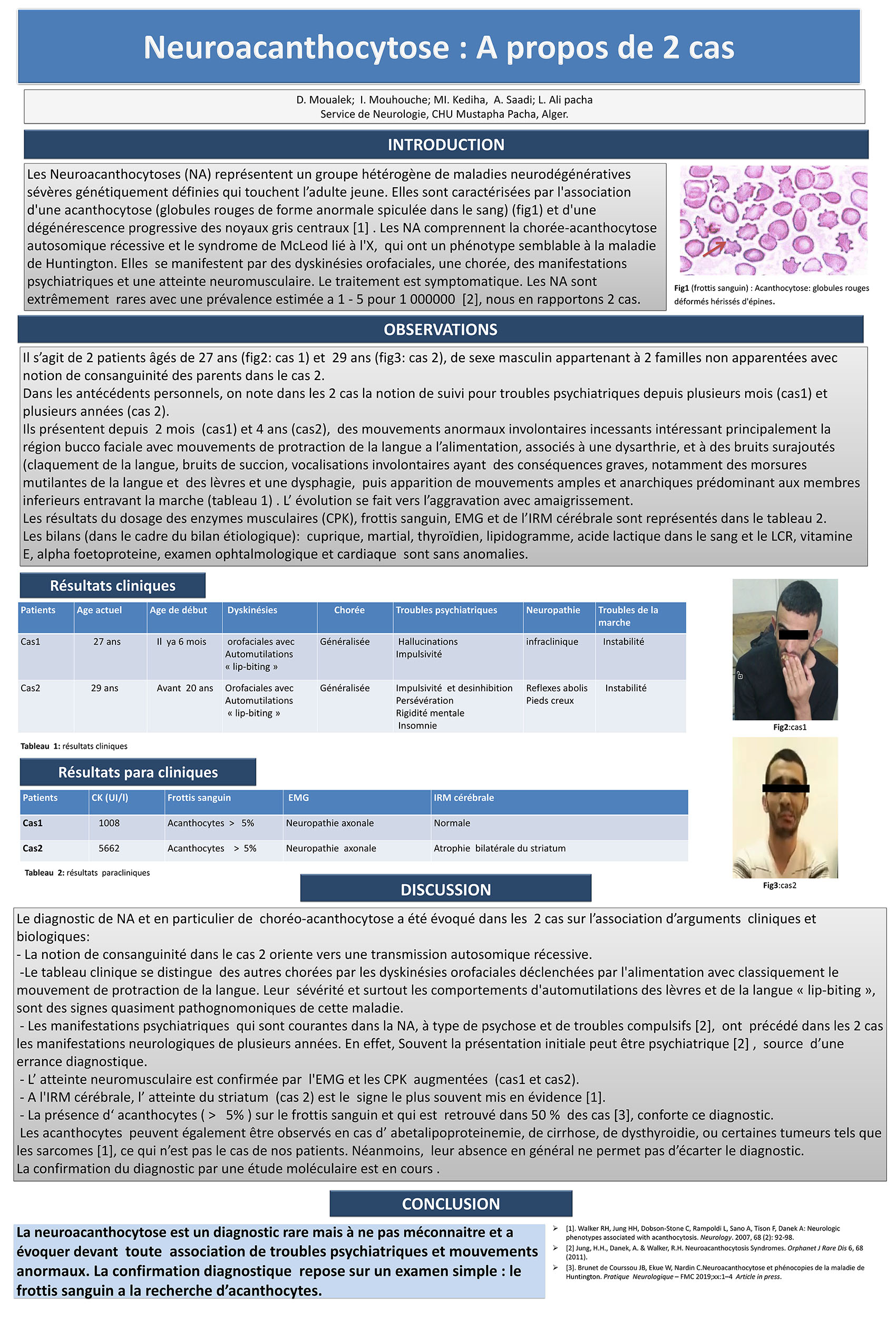 Neuroacanthocytose : A propos de 2 cas