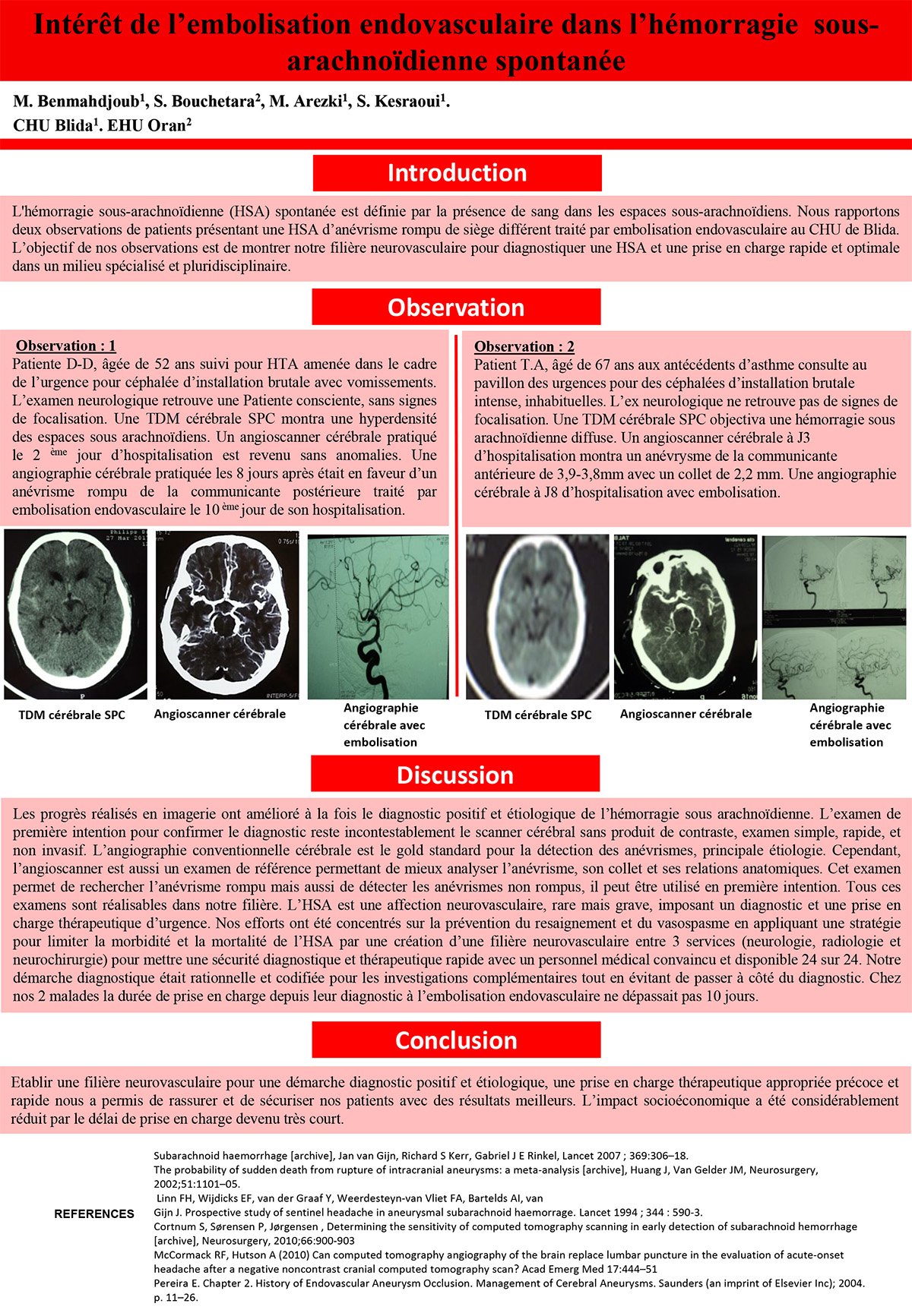 Intérêt de l’embolisation endovasculaire dans l’hémorragie sous-arachnoïdienne spontanée