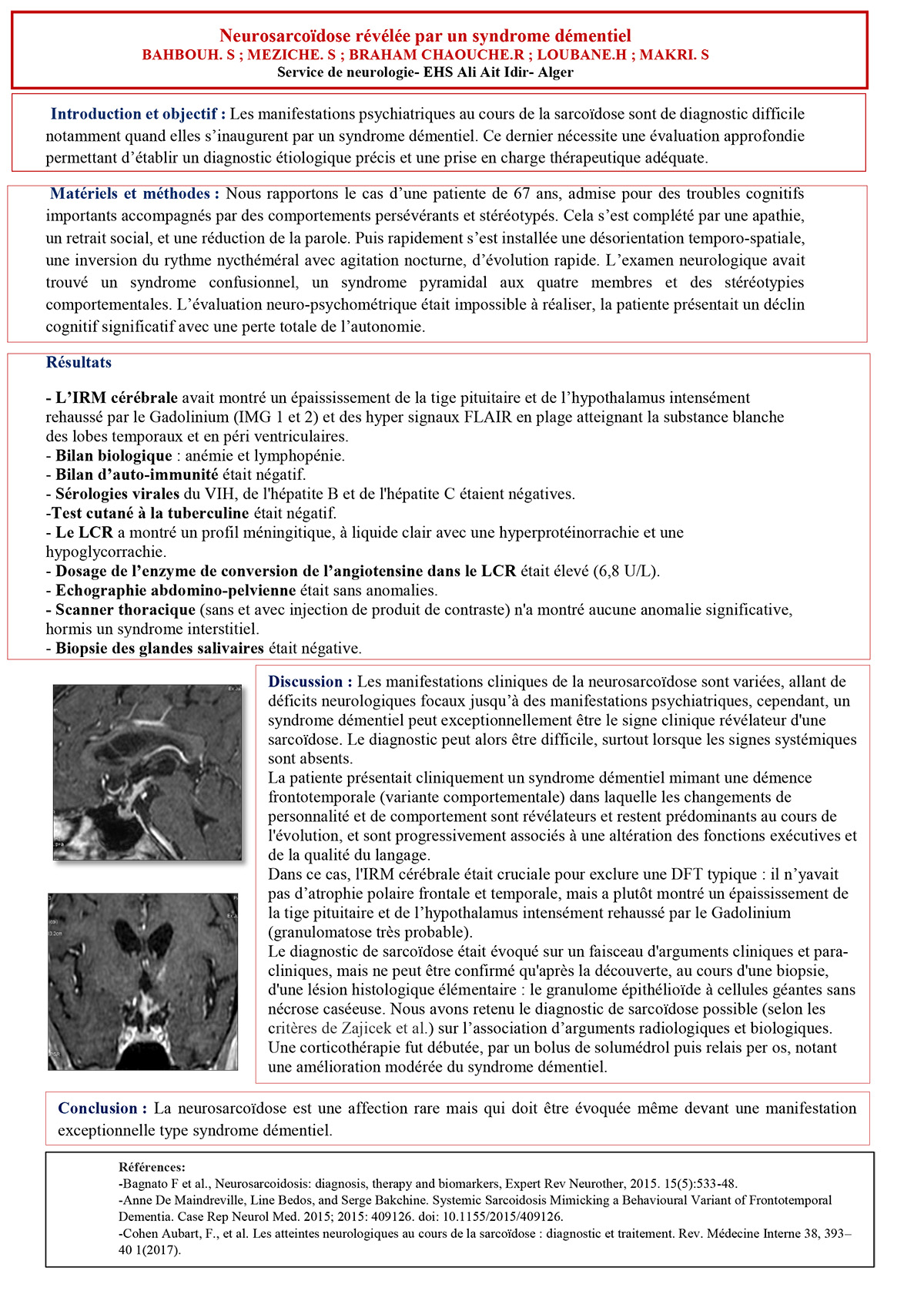 Neurosarcoïdose révélée par un syndrome démentiel