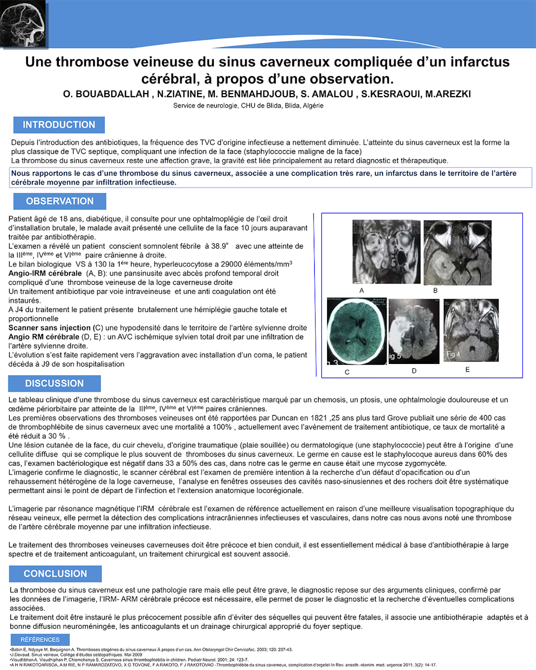 NV-18 Une thrombose veineuse du sinus caverneux compliquée d’un infarctus cérébral, à propos d’une observation.