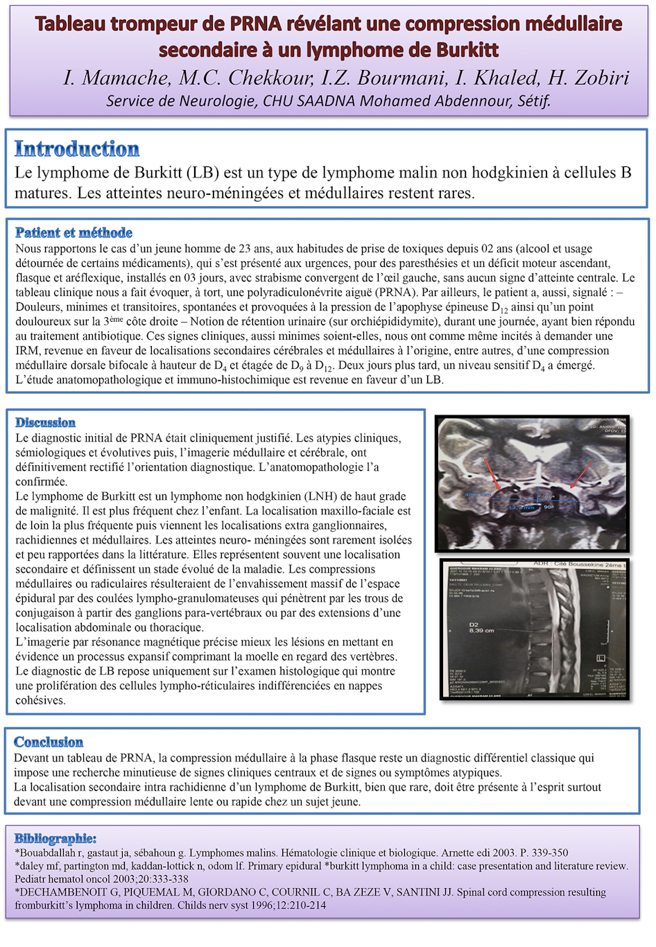 NV-30 Tableau trompeur de PRNA révélant une compression médullaire secondaire à un lymphome de Burkitt.